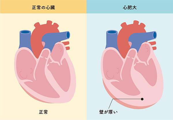 図5 正常な心臓と心肥大